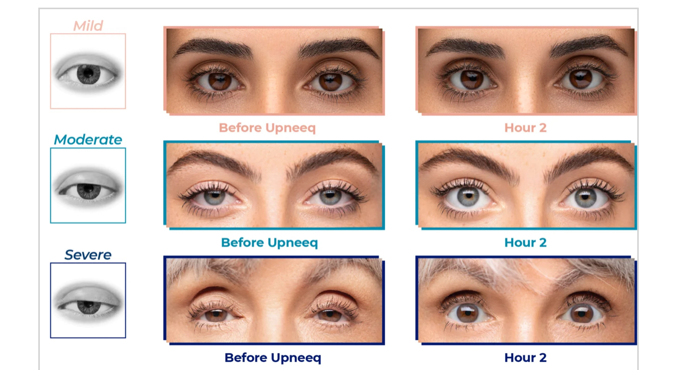 UPNEEQ resoluts from mild to severe before and after 2 hours